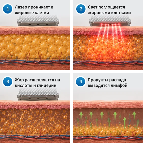 Как работает лазерный липолиз