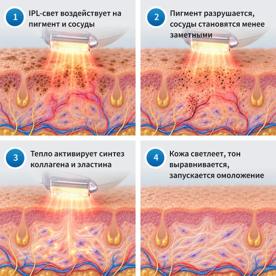 как работает фотомоложение лица
