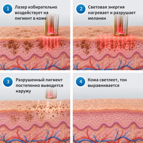 як працює лазерна корекція пігментації