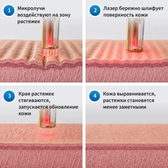 как работает лазерное удаление растяжек