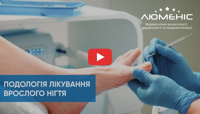 як проходить лікування врослого нігтя