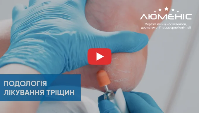 Як проходить процедура лікування тріщин на п’ятах.
