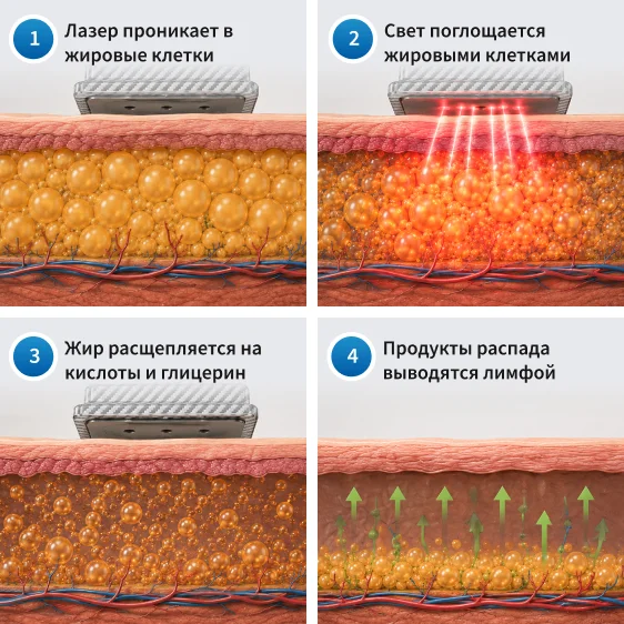 как работает лазерный липолиз