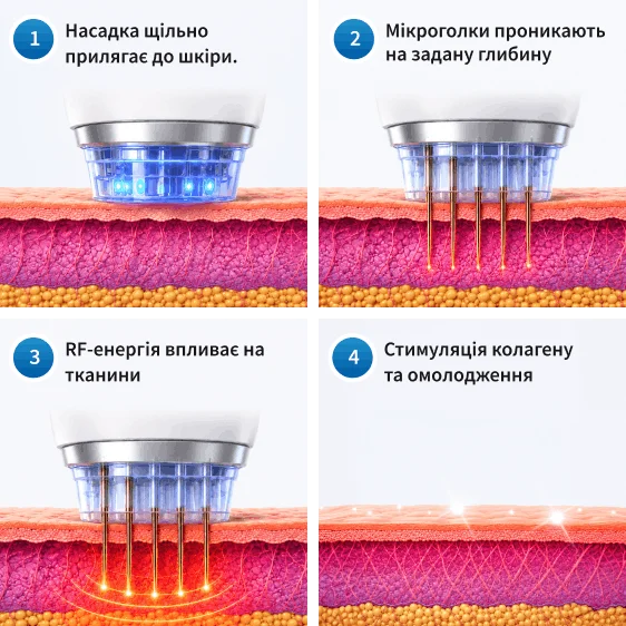 Як працює мікроголковий RF-ліфтинг?