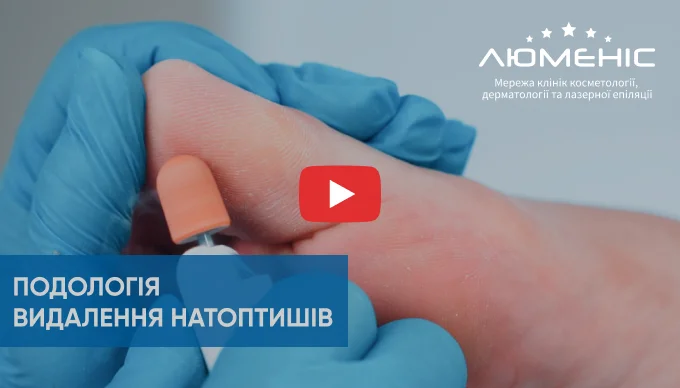 Как проходит удаление натоптышей
